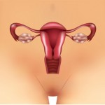 causas del dolor en el Ovario